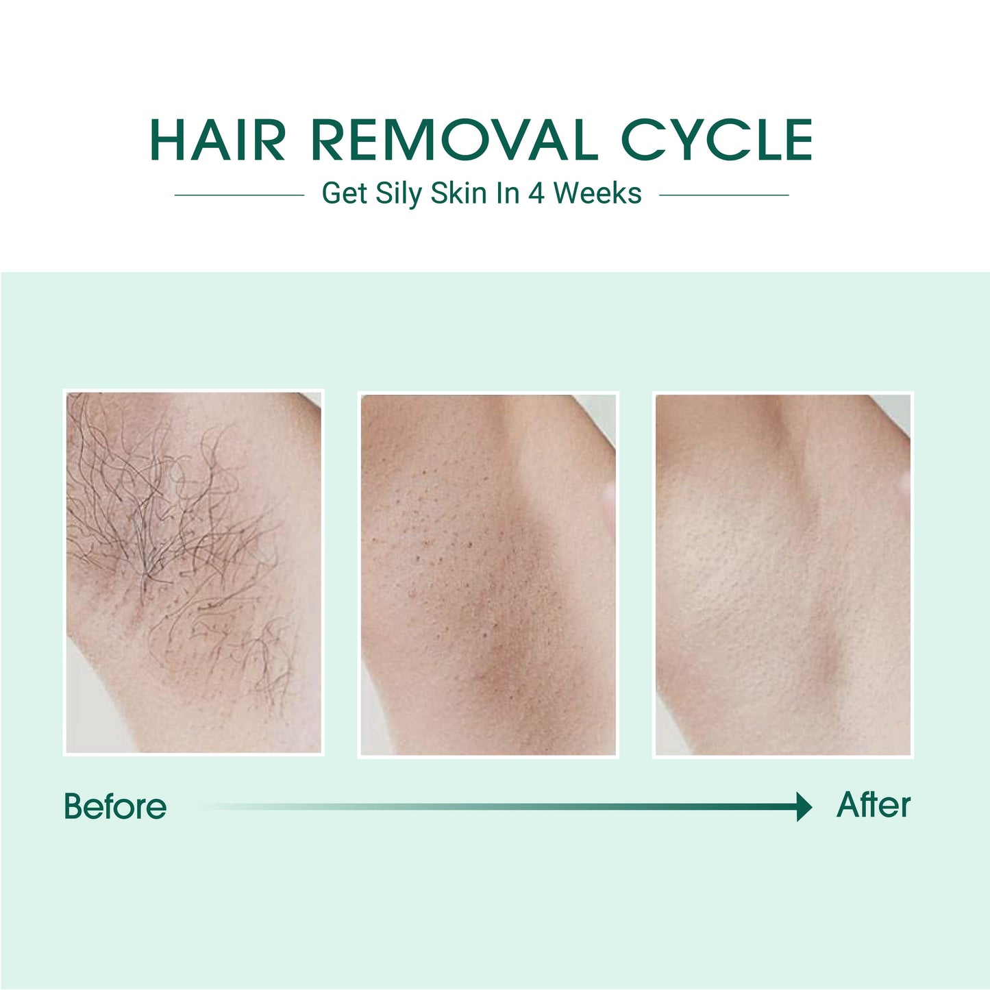 Laser IPL Hair Removal – 999,000 Flashes, Painless & Long‑Lasting Results